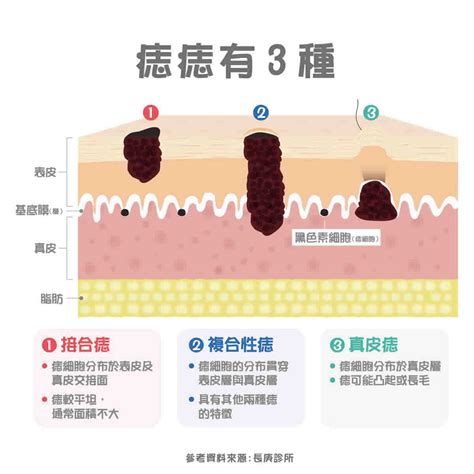 痣 斑|痣變大、痣多或長毛會變皮膚癌？認識痣的形成與原因